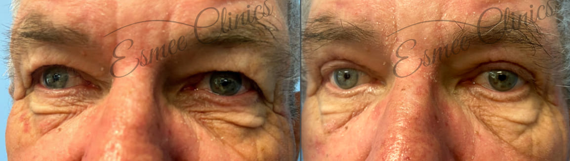 Before and After img